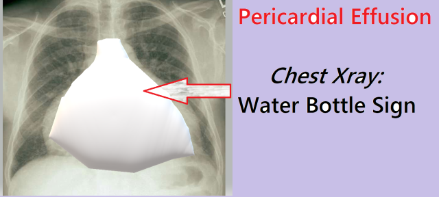 Water bottle Pericardial effusion