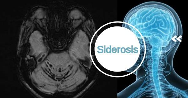 Superficial Siderosis : Importance of Susceptibility MRI Imaging