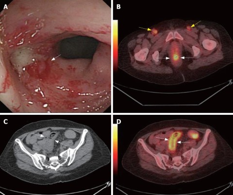 Colon_Cancer