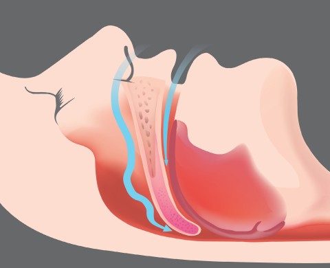 sleep-apnea_G_mri_second-opinion