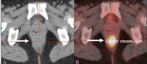 PET/CT or CT Scan Opinion Varies