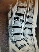 Second opinion : fracture MRI
