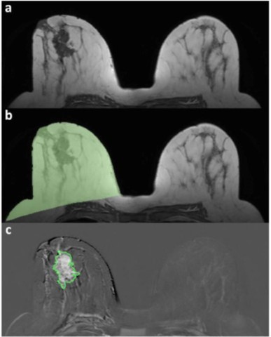 MRI-Breast Evaluation Requires to answer some hard questions