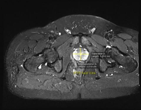 Prostate-measurements-mri