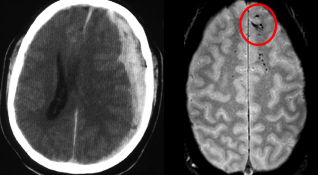 CT Brain Vs MRI Brain